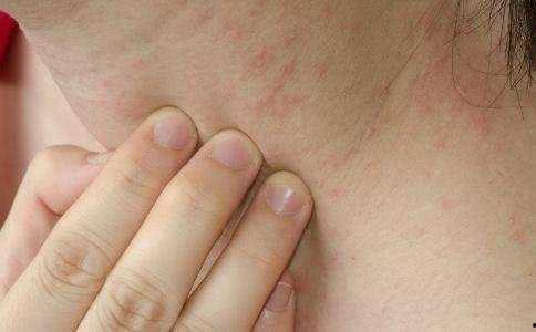 患了湿疹可以吃哈密瓜吗,哈密瓜的益处与注意事项