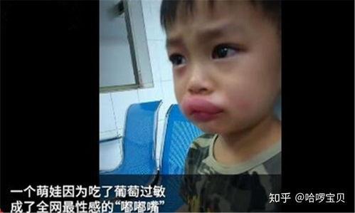 孩子吃瓜嘴巴肿了,家长需警惕这些饮食安全误区